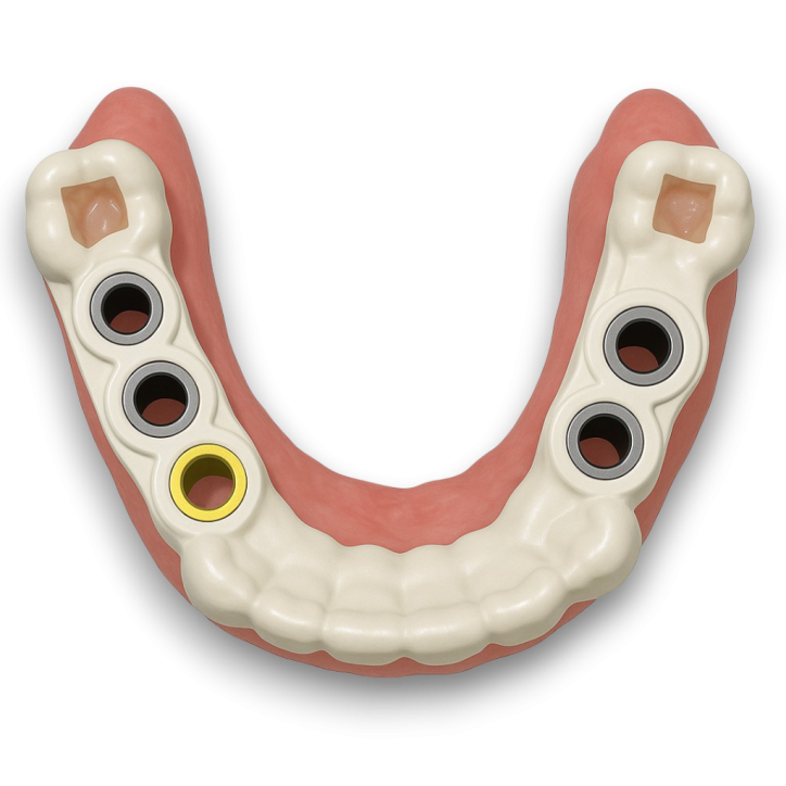 Дентальная имплантация с индивидуальным хирургическим шаблоном без разреза